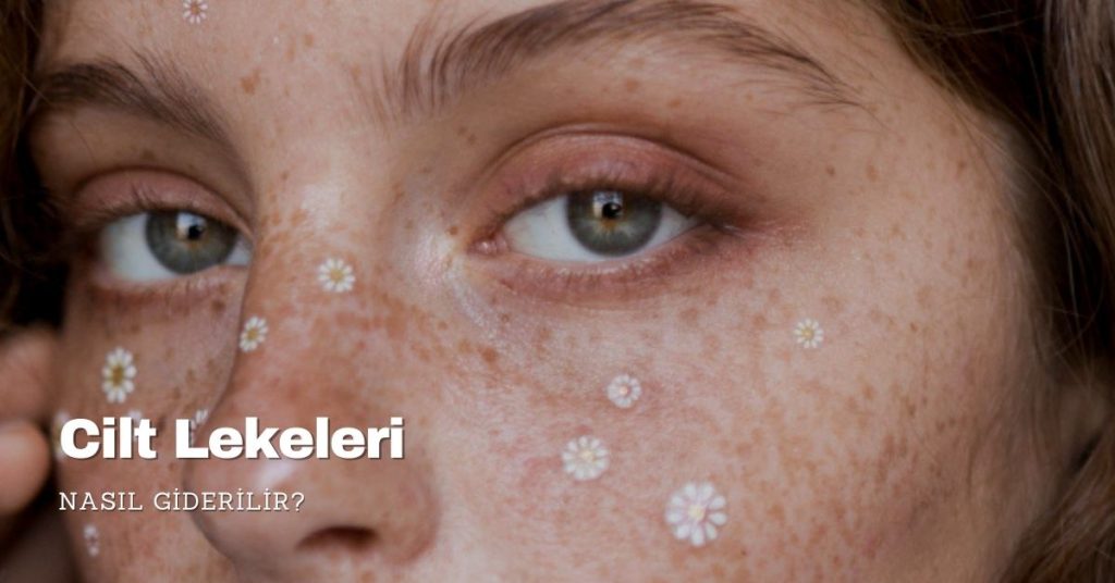 cilt lekeleri