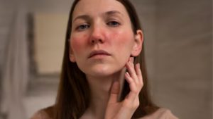 yüz kızarıklığı